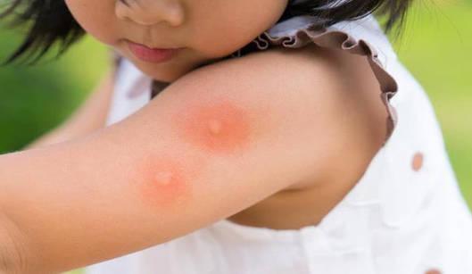 被蚊子咬后，该如何止痒快速有效？