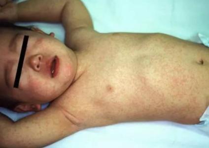 小儿麻疹该如何治疗？