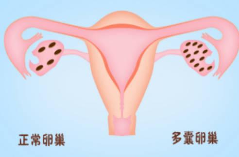 多囊卵巢综合症需要注意什么？