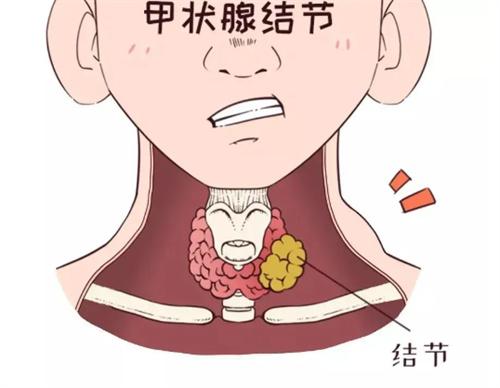 如何判断甲状腺结节是否需要治疗